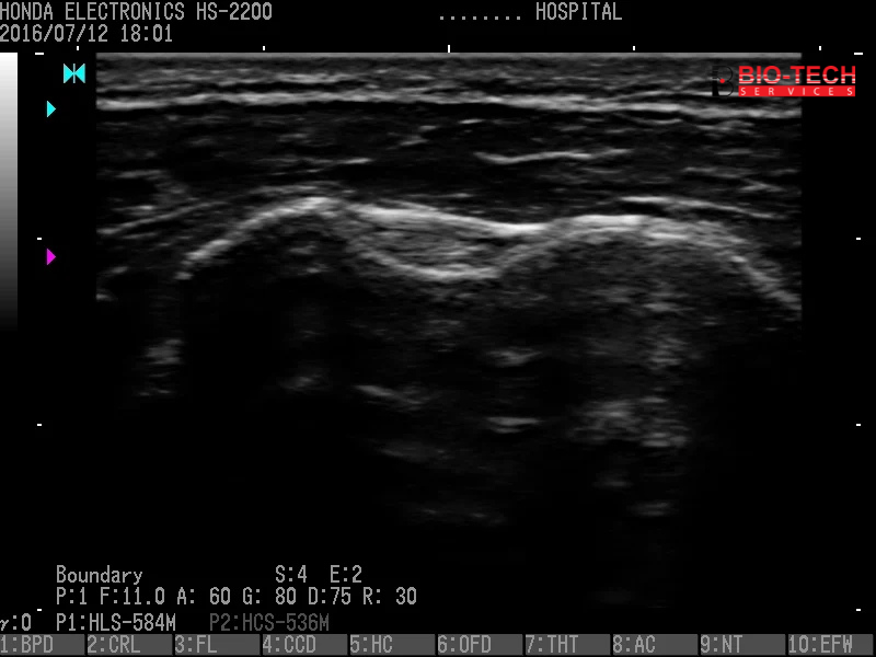 03 Shoulder Boundary