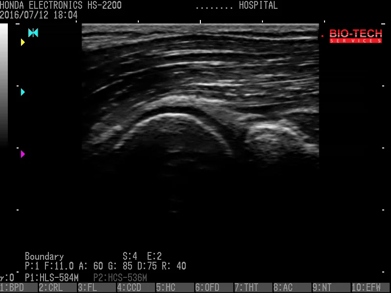 04 Elbow Boundary