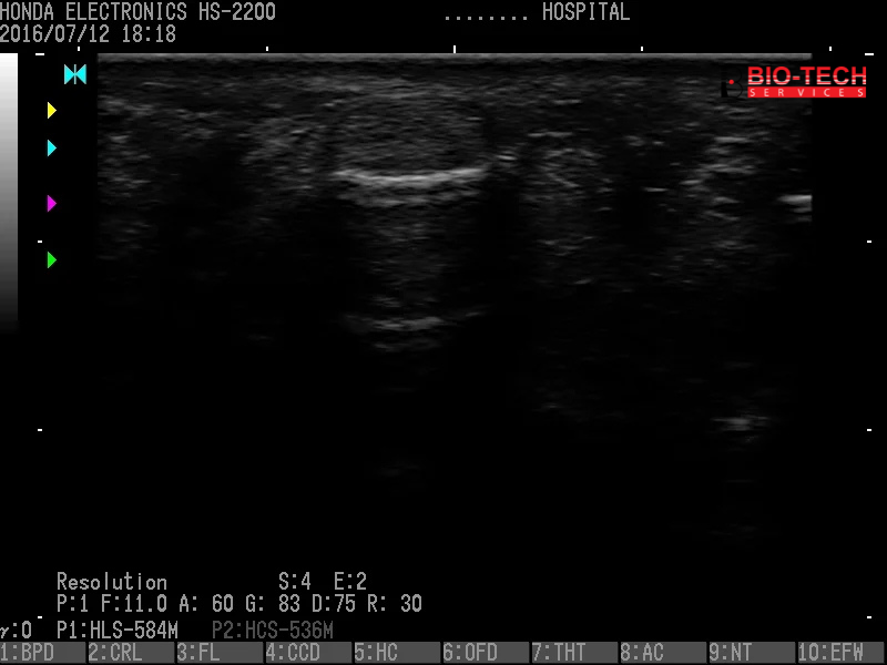 05 Tendon of Middle Finger Resolution
