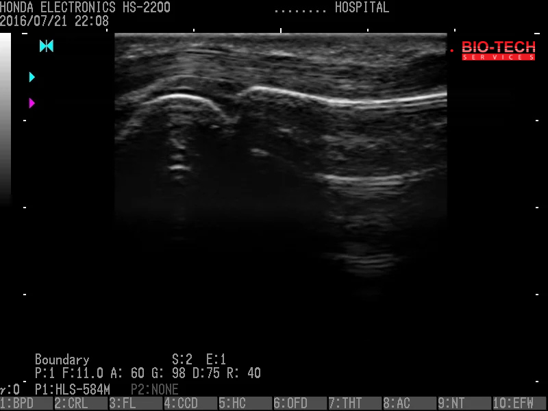 06 Tendon of Middle Finger Boundary
