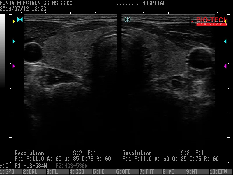 07 Thyroid Gland Resolution